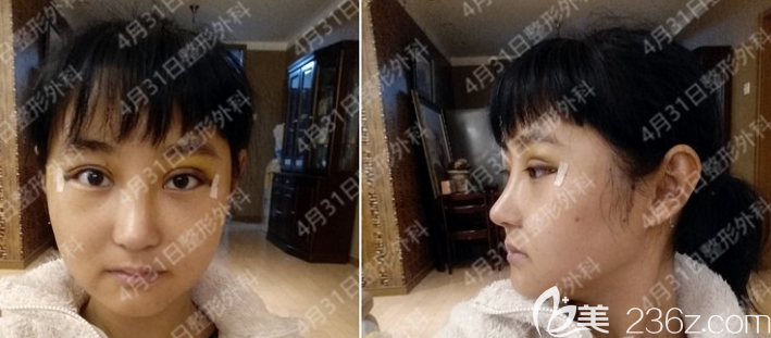 韓國4月31日金載勛隆鼻+自體脂肪填充術(shù)后2周