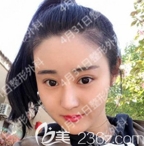 韓國4月31日整形金載勛雙眼皮+鼻綜合隆鼻+自體脂肪填充全臉案例術(shù)后半年恢復(fù)圖