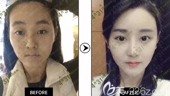 去韓國4月31日整形術(shù)前術(shù)后真實(shí)效果對(duì)比圖