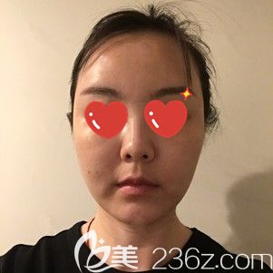 李莎主任幫我做射頻緊膚術(shù)后1天臉部腫脹 李莎主任幫我做射頻緊膚術(shù)后1天臉部腫脹