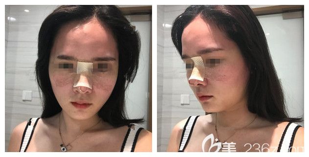 耳軟骨墊鼻尖+艷冠假體鼻修復(fù)術(shù)后三天恢復(fù)情況