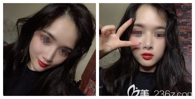 拆線后耳軟骨墊鼻尖+艷冠假體鼻修復(fù)恢復(fù)