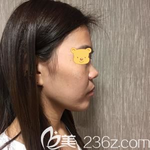 到武漢美基元前自己的塌鼻子 到武漢美基元前自己的塌鼻子