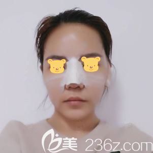 汪福強院長幫我做膨體隆鼻術后即刻 汪福強院長幫我做膨體隆鼻術后即刻