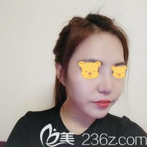 做膨體鼻綜合整形術后7天拆線鼻子消腫 做膨體鼻綜合整形術后7天拆線鼻子消腫