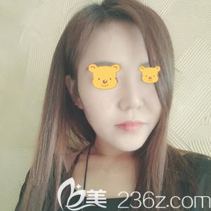 汪院長做膨體隆鼻術后26天鼻子疤痕漸消 汪院長做膨體隆鼻術后26天鼻子疤痕漸消