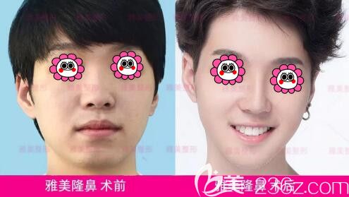 雅美膨體假體隆鼻真人前后對比效果 雅美膨體假體隆鼻真人前后對比效果