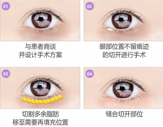 眼底脂肪重制（祛眼袋）方法