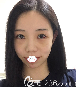 眼底脂肪重排術(shù)后第5天恢復(fù)效果圖