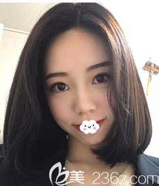 糾結(jié)去除眼袋內(nèi)切好還是外切好，韓國K-angle整形外科眼底脂肪重置恢復(fù)后黑眼圈也不見了