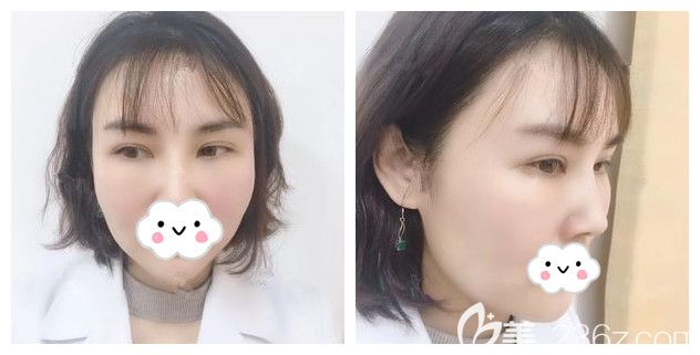 擔(dān)心外切去眼袋會(huì)眼瞼外翻?留疤?復(fù)發(fā)?看過我在南京華韓奇致做的去眼袋就知道專業(yè)醫(yī)生不會(huì)出現(xiàn)以上副作用