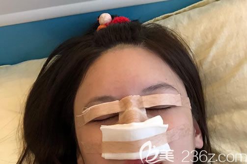 剛做完雙眼皮和隆鼻手術(shù)圖片