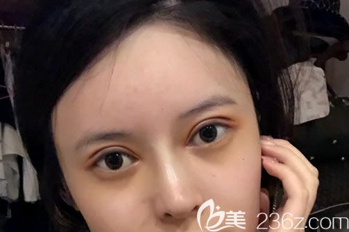 溫州藝星做雙眼皮和隆鼻7天后