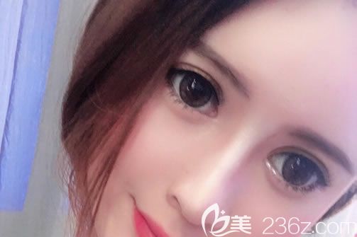 溫州藝興整形醫(yī)院林文君隆鼻<span style=