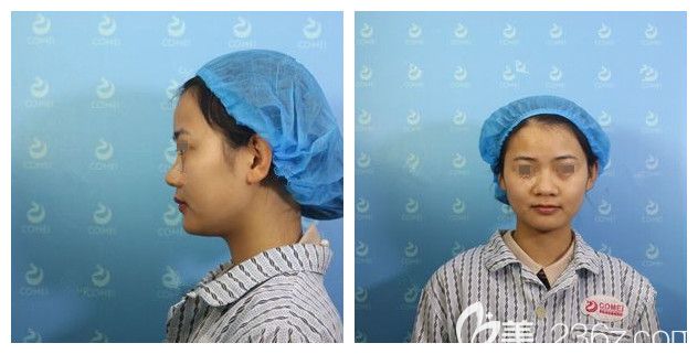 面診<!--<i data=20240703-sp></i>-->術(shù)前鼻子塌下巴短 面診<!--<i data=20240703-sp></i>-->術(shù)前鼻子塌下巴短