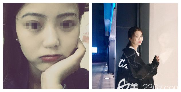 術(shù)后一周鼻子下巴拆線恢復(fù)情況 術(shù)后一周鼻子下巴拆線恢復(fù)情況