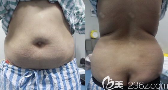 在寧波雅韓做腰腹部吸脂術(shù)前 在寧波雅韓做腰腹部吸脂術(shù)前