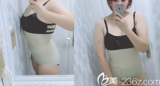 做腰腹部抽脂手術(shù)7天效果圖片 做腰腹部抽脂手術(shù)7天效果圖片