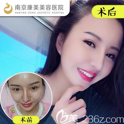 到做眼鼻整形案例