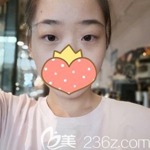 到武漢美基元做玻尿酸豐淚溝術(shù)前沉重的淚溝 到武漢美基元做玻尿酸豐淚溝術(shù)前沉重的淚溝