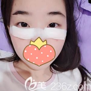 彭強醫(yī)生幫我做玻尿酸豐淚溝術(shù)后即刻 彭強醫(yī)生幫我做玻尿酸豐淚溝術(shù)后即刻