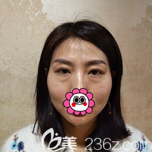 在武漢美基元做去眼袋和面部填充前的自己 在武漢美基元做去眼袋和面部填充前的自己