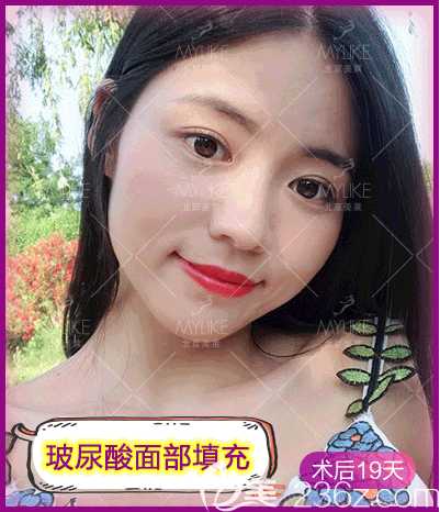 戴琴醫(yī)生給我做玻尿酸面部填充第19天效果