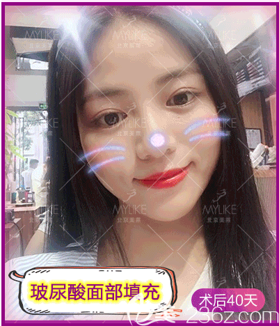 我在北京美萊做玻尿酸面部填充第40天效果