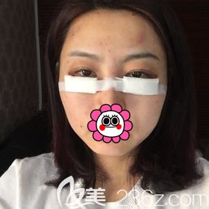 汪院長幫我做內(nèi)切去眼袋+面部填充術后即刻 汪院長幫我做內(nèi)切去眼袋+面部填充術后即刻