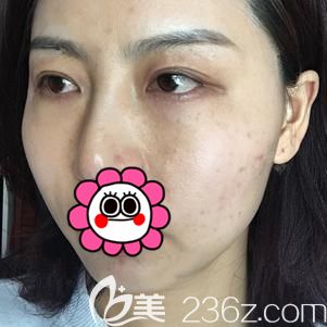 做內(nèi)切去眼袋+自體脂肪面部填充術后17天臉部腫脹未消 做內(nèi)切去眼袋+自體脂肪面部填充術后17天臉部腫脹未消