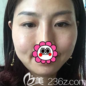 汪院長做內(nèi)切去眼袋+面部填充術后35天臉頰腫脹消除 汪院長做內(nèi)切去眼袋+面部填充術后35天臉頰腫脹消除