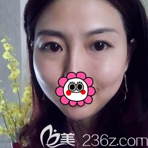 在武漢美基元做內切去眼袋+面部填充78天后效果還不錯，就想把我的經(jīng)歷分享給大家看看