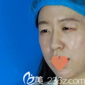 在鄭州華領(lǐng)做雙眼皮和開眼角術(shù)前是無神三角眼 在鄭州華領(lǐng)做雙眼皮和開眼角術(shù)前是無神三角眼