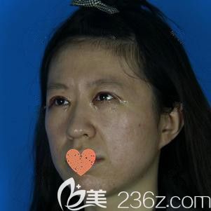 在鄭州華領(lǐng)剛做完雙眼皮和開眼角術(shù)后眼睛腫脹 在鄭州華領(lǐng)剛做完雙眼皮和開眼角術(shù)后眼睛腫脹