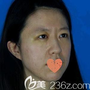 蘇鈺醫(yī)生為我做眼綜合術(shù)后7天進(jìn)行拆線 蘇鈺醫(yī)生為我做眼綜合術(shù)后7天進(jìn)行拆線