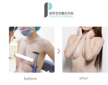 韓國蓓拉假體隆胸真人案例