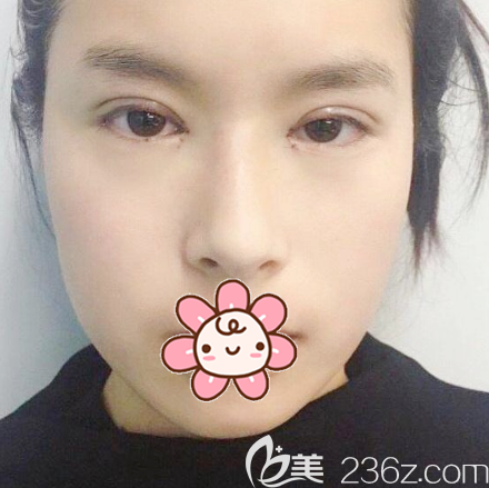 雙眼皮開眼角術(shù)后7天拆線