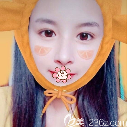 李子鵬醫(yī)生雙眼皮開眼角案例術(shù)后15天