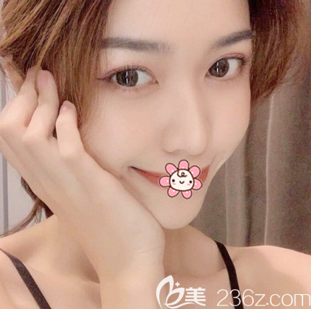 深圳鵬程醫(yī)院龐清澤做的脂肪填充案例兩個月效果很自然 深圳鵬程醫(yī)院龐清澤做的脂肪填充案例兩個月效果很自然