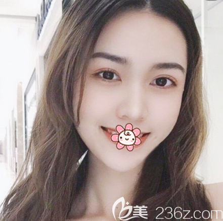 深圳脂肪填充哪里好？公開我在深圳鵬程醫(yī)院找龐清澤做自體脂肪面部填充兩個月恢復全過程