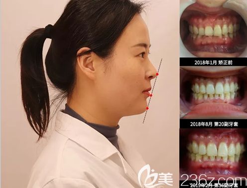 賈艷主任給自己做的隱形矯正效果圖