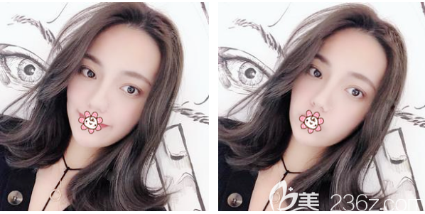 <!--<i data=20240703-sp></i>-->整形醫(yī)院李鵬醫(yī)生割雙眼皮案例 <!--<i data=20240703-sp></i>-->整形醫(yī)院李鵬醫(yī)生割雙眼皮案例