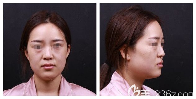 面診蘇州紫馨醫(yī)生術(shù)前歪鼻頭面部顯老 面診蘇州紫馨醫(yī)生術(shù)前歪鼻頭面部顯老