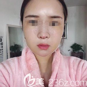 術(shù)后三天鼻綜合和面部脂肪填充恢復情況 術(shù)后三天鼻綜合和面部脂肪填充恢復情況