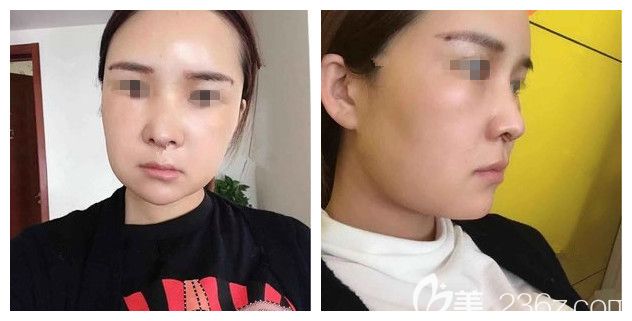 一周后鼻綜合+脂肪填充恢復效果 一周后鼻綜合+脂肪填充恢復效果