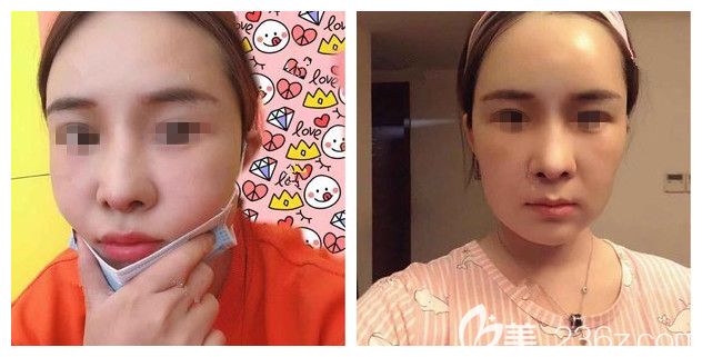 半個月后鼻綜合+面部脂肪填充恢復 半個月后鼻綜合+面部脂肪填充恢復