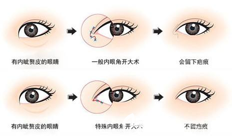 開眼角失敗修復(fù)過程示意圖 開眼角失敗修復(fù)過程示意圖