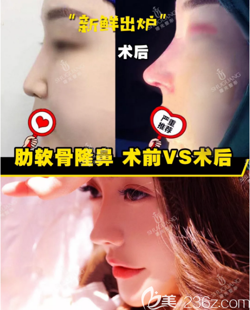 梅州曙光整形醫(yī)院肋軟骨隆鼻案例