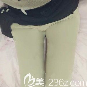 術(shù)后三天大腿吸脂的恢復(fù)情況