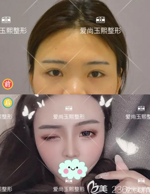 朱剛強(qiáng)隆鼻案例 朱剛強(qiáng)隆鼻案例